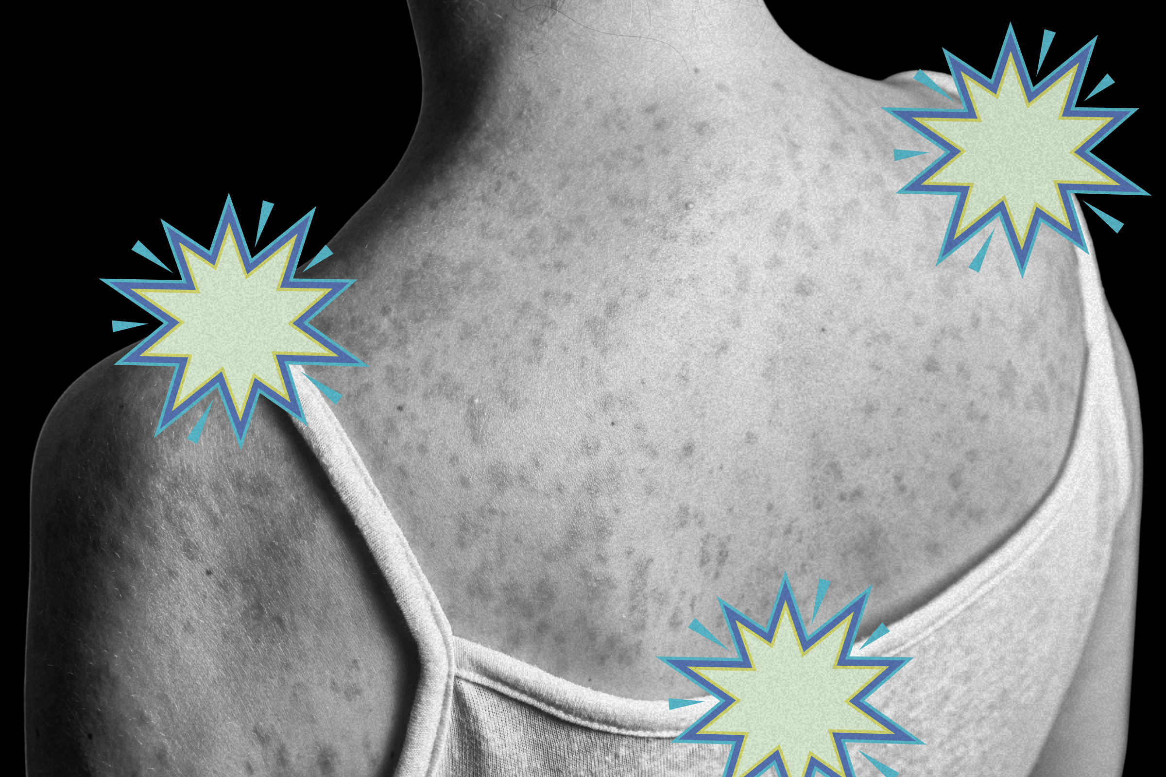 The Long-Term Measles Complication Most People Don't Know About