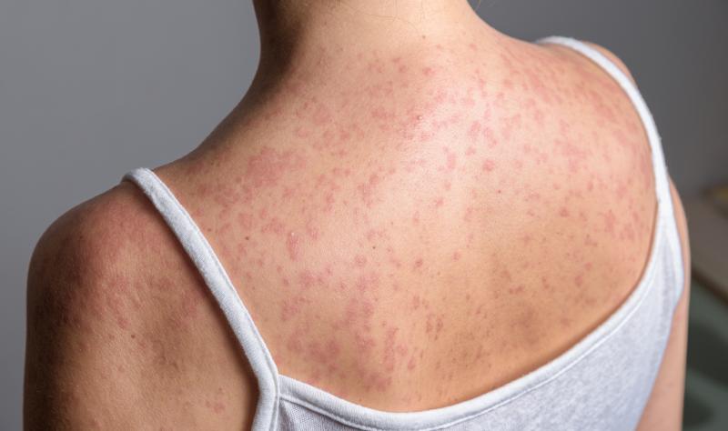 US ‘highly likely’ to lose measles elimination status this fall, analysis warns