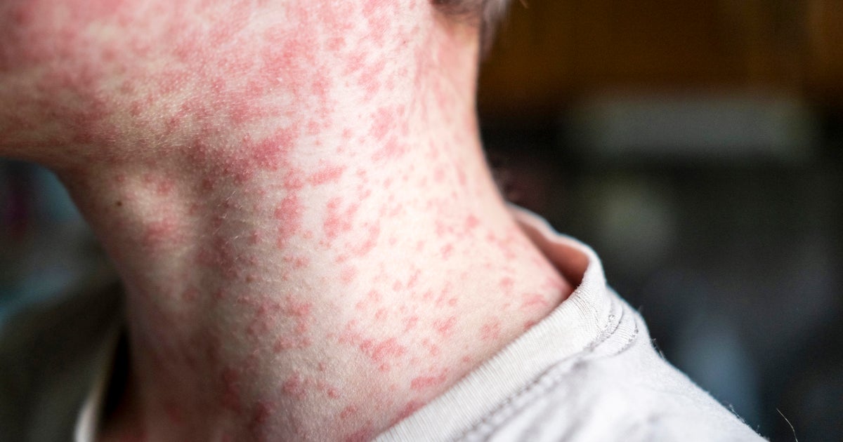 Measles diagnosed in 2 Massachusetts residents, state says