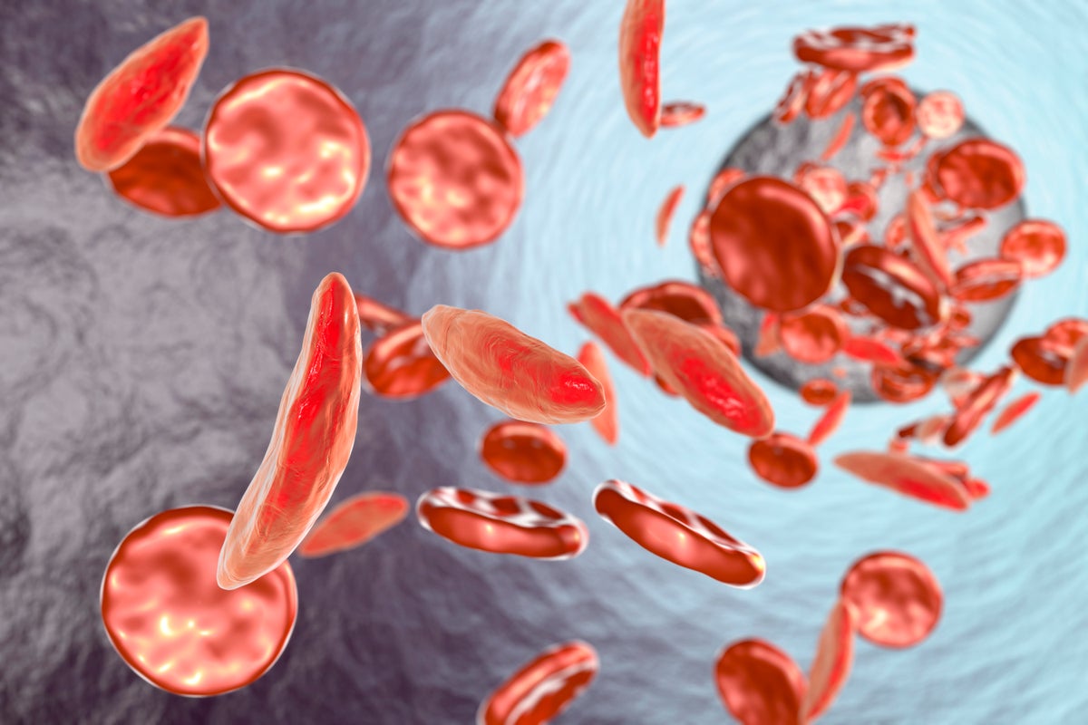 The scientists whose work led to a game-changing therapy for sickle cell disease worry those most vulnerable can’t access it