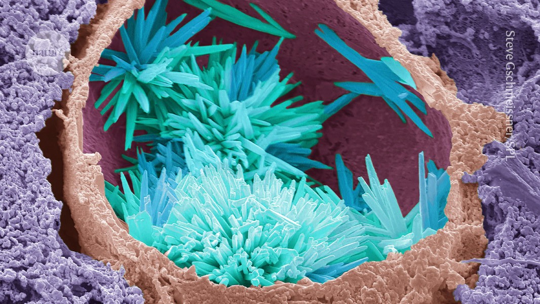 CRISPR vs cholesterol: can gene editing prevent heart disease?